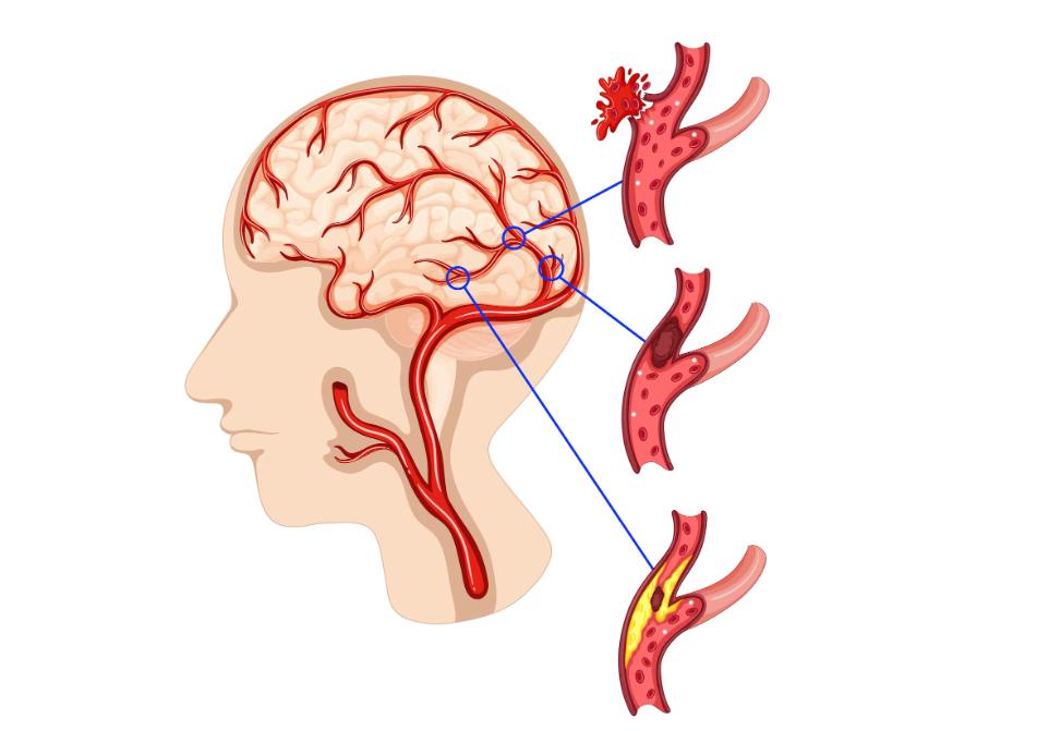 Phục hồi sau tai biến mạch máu não: Giúp lưu thông khí huyết, cải thiện vận động, phục hồi chức năng